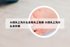 小孩頭上為什么會有頭上有癬 小孩頭上為什么會長癬