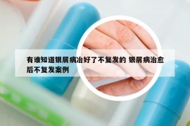 有誰知道銀屑病冶好了不復(fù)發(fā)的 銀屑病治愈后不復(fù)發(fā)案例