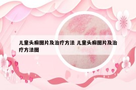 兒童頭癬圖片及治療方法 兒童頭癬圖片及治療方法圖