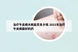 治療牛皮癬大概能花多少錢 2021年治療牛皮癬最好的藥