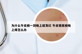 為什么牛皮癬一到晚上就發(fā)紅 牛皮銀屑癬晚上癢怎么辦