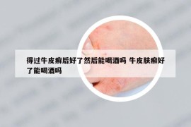 得過牛皮癬后好了然后能喝酒嗎 牛皮膚癬好了能喝酒嗎