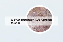 12歲小孩銀屑病怎么辦 12歲小孩銀屑病怎么辦呢