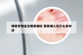哪些食物適合銀屑病吃 銀屑病人吃什么食材好