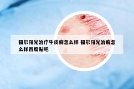 福爾陽光治療牛皮癬怎么樣 福爾陽光治癬怎么樣百度貼吧
