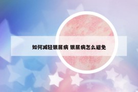 如何減輕銀屑病 銀屑病怎么避免