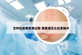 怎樣檢查銀屑病過敏 銀屑病怎么檢查確診