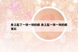 身上起了一塊一塊的癬 身上起一塊一塊的癬發(fā)紅