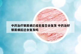 中藥治療銀屑病已痊愈是否會復發(fā) 中藥治好銀屑病后還會復發(fā)嗎