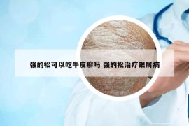 強(qiáng)的松可以吃牛皮癬嗎 強(qiáng)的松治療銀屑病