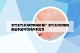 急性急性點(diǎn)滴狀銀屑病治療 急性點(diǎn)滴狀銀屑病是不是可以終身不復(fù)發(fā)