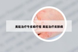 美能治療牛皮癬療程 美能治療皮膚病