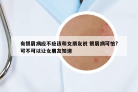 有銀屑病應(yīng)不應(yīng)該和女朋友說 銀屑病可怕?可不可以讓女朋友知道