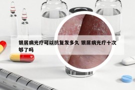 銀屑病光療可以抗復發(fā)多久 銀屑病光療十次夠了嗎