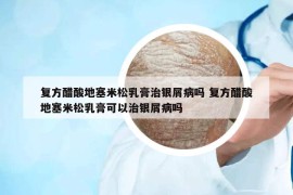 復(fù)方醋酸地塞米松乳膏治銀屑病嗎 復(fù)方醋酸地塞米松乳膏可以治銀屑病嗎