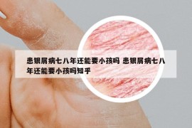 患銀屑病七八年還能要小孩嗎 患銀屑病七八年還能要小孩嗎知乎