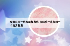 皮癬在同一地方反復(fù)發(fā)嗎 皮膚癬一直在同一個(gè)地方復(fù)發(fā)