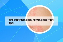 指甲上我會(huì)有銀屑病嗎 指甲銀屑病是什么引起的