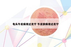 龜頭牛皮癬用達(dá)克寧 牛皮膚癬用達(dá)克寧