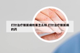 打針治療銀屑病效果怎么樣 打針治療銀屑病的藥