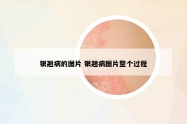 銀翹病的圖片 銀翹病圖片整個過程