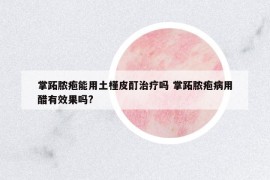 掌跖膿皰能用土槿皮酊治療嗎 掌跖膿皰病用醋有效果嗎?