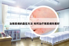 治銀屑病的最佳方法 如何治療銀屑病效果好