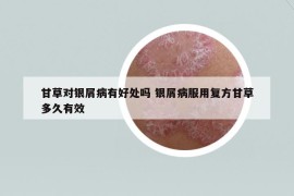 甘草對銀屑病有好處嗎 銀屑病服用復(fù)方甘草多久有效