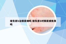 維生素b治銀屑病嗎 維生素b對銀屑病有用嗎