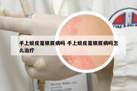 手上蛻皮是銀屑病嗎 手上蛻皮是銀屑病嗎怎么治療
