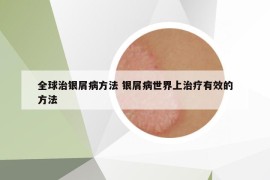 全球治銀屑病方法 銀屑病世界上治療有效的方法