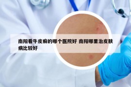 南陽(yáng)看牛皮癬的哪個(gè)醫(yī)院好 南陽(yáng)哪里治皮膚病比較好