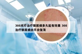 308光療治療銀屑病多久能有效果 308治療銀屑病會(huì)不會(huì)復(fù)發(fā)