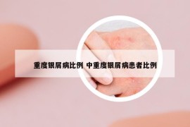 重度銀屑病比例 中重度銀屑病患者比例