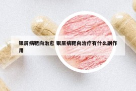 銀屑病靶向治愈 銀屑病靶向治療有什么副作用