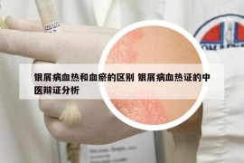 銀屑病血熱和血瘀的區(qū)別 銀屑病血熱證的中醫(yī)辯證分析