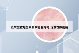 泛發(fā)型膿皰型銀屑病能看好吧 泛發(fā)性膿皰瘡
