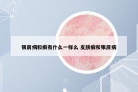 銀屑病和癬有什么一樣么 皮膚癬和銀屑病