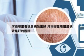 河南哪里看銀屑病效果好 河南哪里看銀屑病效果好的醫(yī)院
