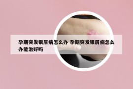 孕期突發(fā)銀屑病怎么辦 孕期突發(fā)銀屑病怎么辦能治好嗎