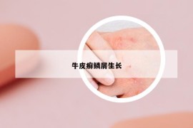 牛皮癬鱗屑生長
