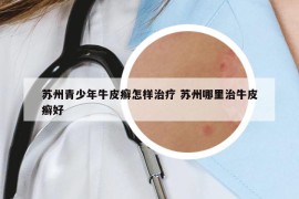 蘇州青少年牛皮癬怎樣治療 蘇州哪里治牛皮癬好