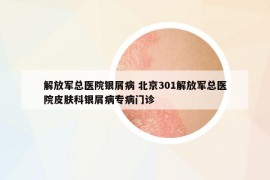 解放軍總醫(yī)院銀屑病 北京301解放軍總醫(yī)院皮膚科銀屑病專病門診