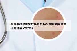 銀屑病打修美樂(lè)效果差怎么辦 銀屑病用修美樂(lè)幾針后又復(fù)發(fā)了