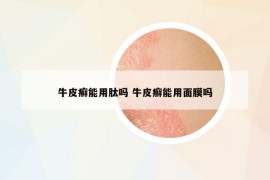 牛皮癬能用肽嗎 牛皮癬能用面膜嗎