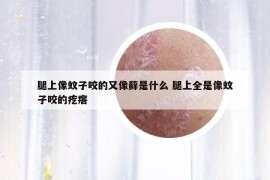 腿上像蚊子咬的又像蘚是什么 腿上全是像蚊子咬的疙瘩