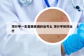 頂針甲一定是銀屑病的信號么 頂針甲如何治療