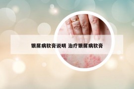 銀屑病軟膏說明 治療銀屑病軟膏