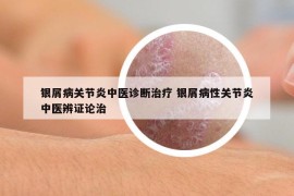 銀屑病關(guān)節(jié)炎中醫(yī)診斷治療 銀屑病性關(guān)節(jié)炎中醫(yī)辨證論治