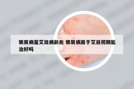 銀屑病是艾滋病前兆 銀屑病屬于艾滋初期能治好嗎